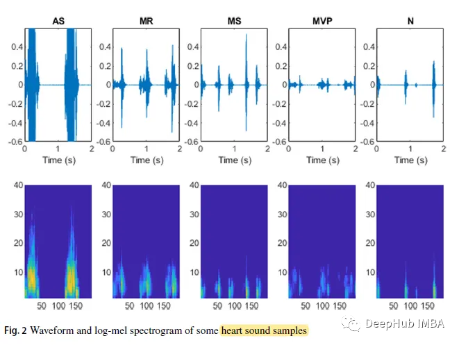 基于对数谱图的深度学习心音分类