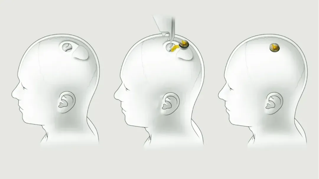 马斯克Neuralink植入物出故障：受试者接线脱落